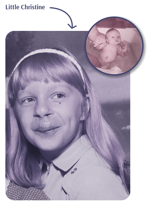 Christine Errico Cleft Lip and Palate Confidence Coach - Childhood Photo